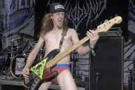 VULVODYNIA
